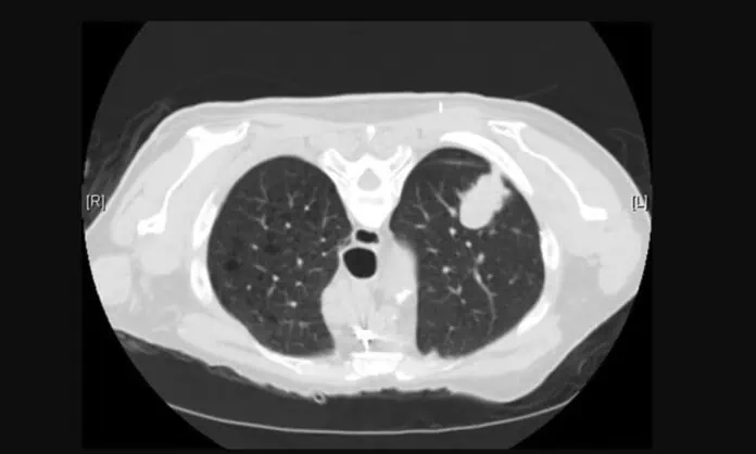 akciğer tomografisi