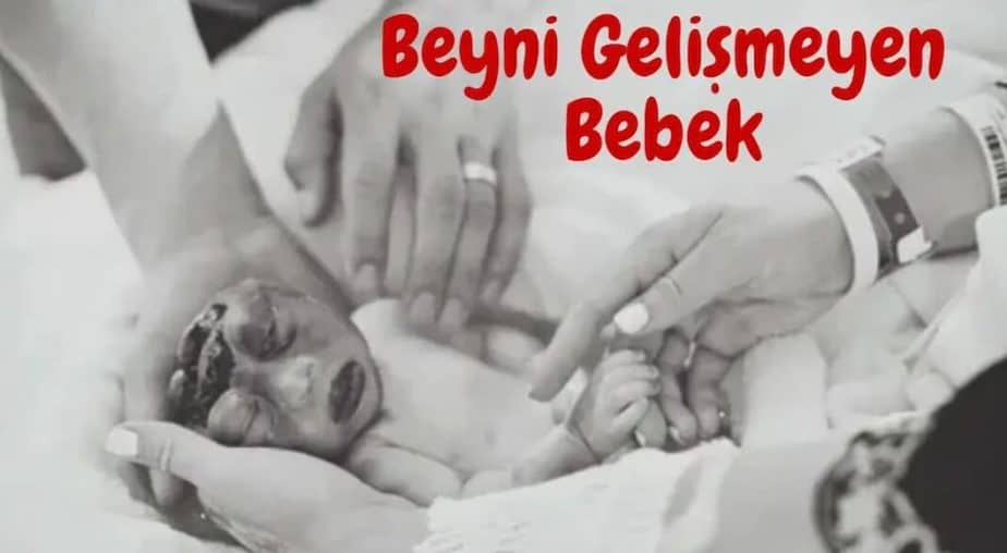 Anne Karnında Beyni Gelişmeyen Bebek Uzm. Dr. Gülhiz KARATAŞ