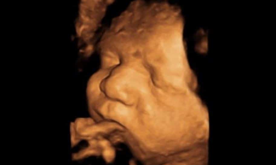 20 haftalık ayrıntılı ultrason görüntüleri