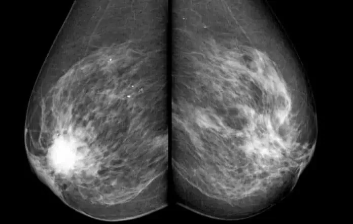 mamografi çekimi